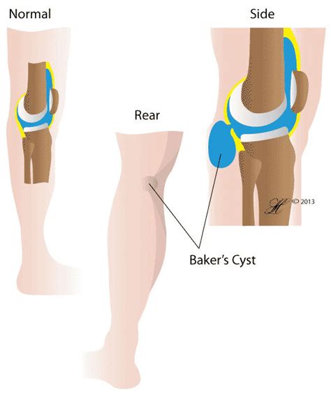 Baker S Cyst Orthoanswer