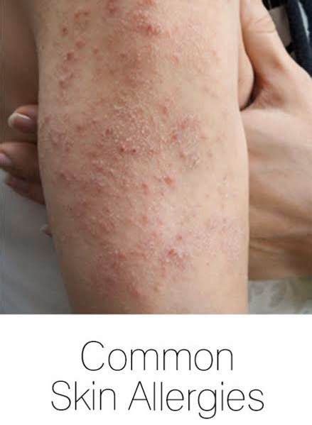 Allergic Skin Rashes That Itch Sekaie