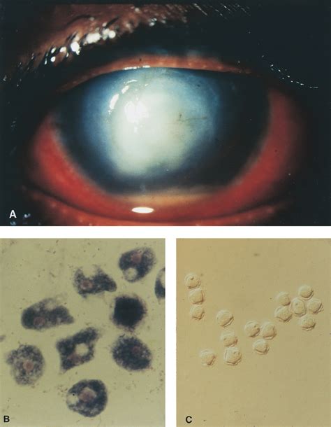 A Right Eye Showing Central Corneal Ulcer Ring Shaped Stromal
