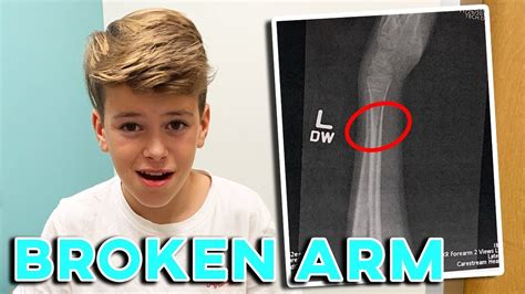 11 Year Old Breaks Arm At Friends House First Broken Arm First