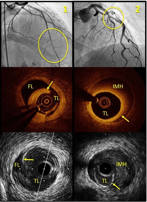 Spontaneous Coronary Artery Dissection Contemporary Aspects Of