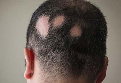 Alopecia Areata Causes Symptoms And Treatment Options