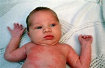 Baby Rash Pictures, Causes, Treatments - Mommyhood101