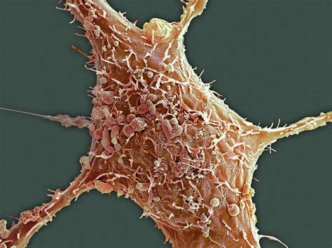 Cancer Cell Under Electron Microscope