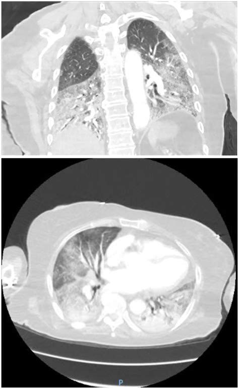 Bevacizumab Induced Pneumonitis In A Patient With Metastatic Colon