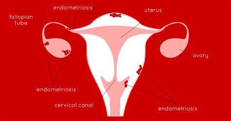 Endometriosis By Ruby Cup Editor