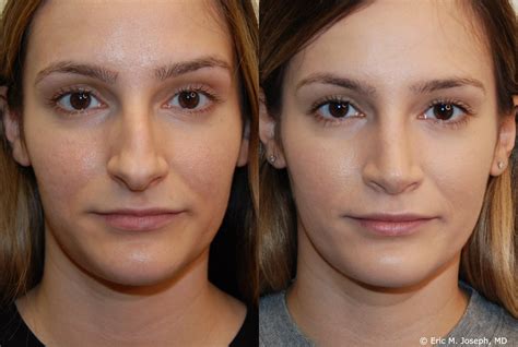 Eric M Joseph Md Rhinoplasty Before And After Results With Thin