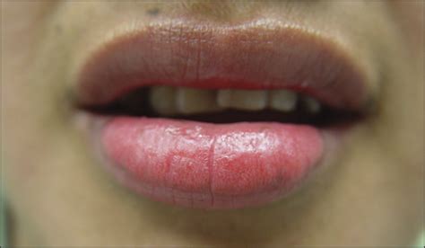 Crusted Swollen Lower Lip—quiz Case Jama Dermatology Jama Network