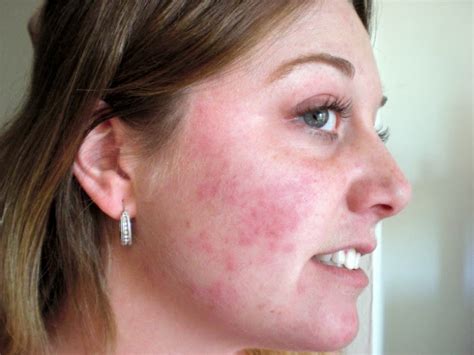 What Can A Swollen Face And Rash Indicate New Health Advisor