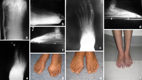 Great Toe Metatarsophalangeal Arthrodesis For Hallux Valgus Deformity