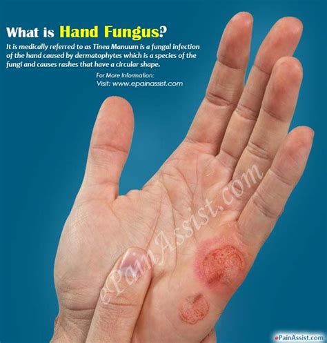 Fungal Skin Rash Identification