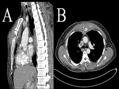 Computed Tomography Ct Scan Sternomanubrial Joint Bone Erosion And