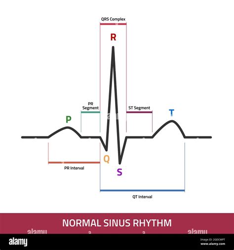 Ekg Showing Normal Heartbeat Wave Ecg Of Normal Sinus Rhythm