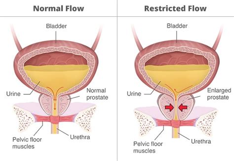 Definition And Facts Of Urinary Retention Niddk