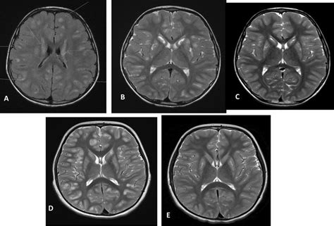 Brain Mri Of Two Patients Patient 1 Ac Patient 2 D E With