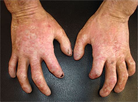 Scleroderma Like Hands In A 16 Year Old Boy Dermatology Jama