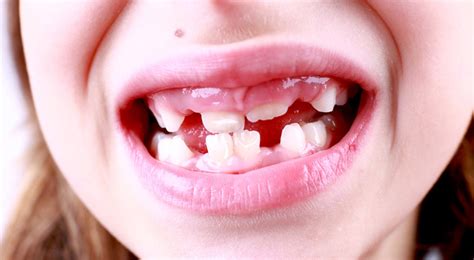 White Spots On Teeth Teethwalls