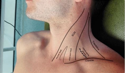 Photograph Showing The Posterior Triangle Of The Neck The Clavicular Download Scientific