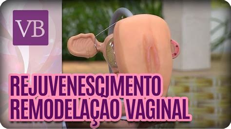 Você Bonita Rejuvenescimento vaginal 13 05 16 YouTube