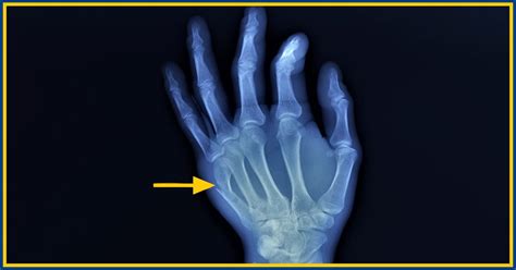 Boxers Fracture Hand Specialist Brandon P Donnelly Md