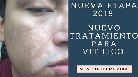 Nuevo Tratamiento Para Vitiligo 2018 Youtube