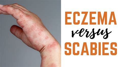 Scabies Vs Eczema Causes Symptoms Treatments Eczema Helpline