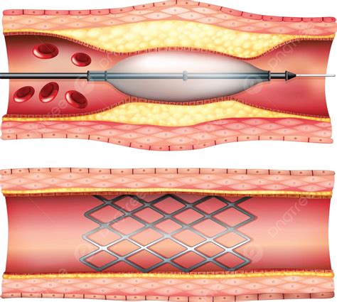 Stent Angioplasty Illustration Interventional Procedure Education
