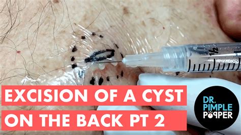 Excision Of Cyst On Back Part Ii Of Ii For Medical Education Nsfe
