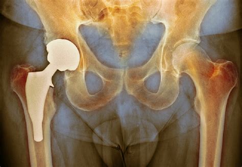 Risk For Prosthetic Joint Infection Surgical Revision After Total