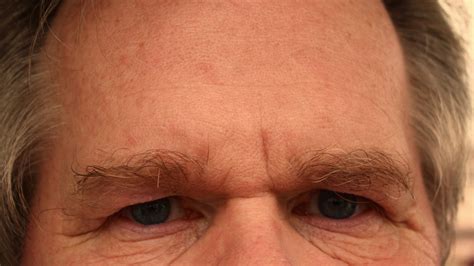 Deep Forehead Wrinkles Mark A Higher Risk Of Dying From Cardiovascular