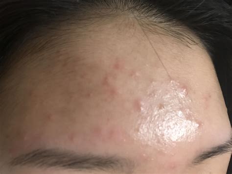 Best Way To Treat “under The Skin” Acne Racne