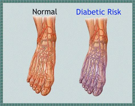 Take care of your feet, especially if. Alcoholic Neuropathy Symptoms Numbness in the arms and ...
