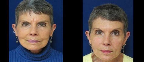 Botox Patient Before And After Gallery Advanced Skin Care Laser