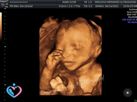 pregnancy ultrasound image gallery 17 24 weeks