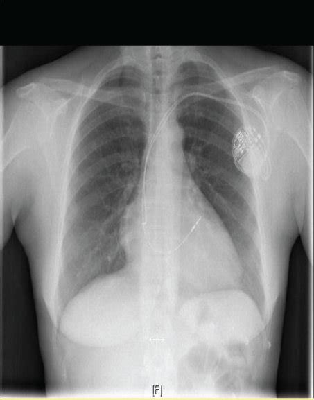 A Chest X Ray Immediately Following Pacemaker Insertion Procedure