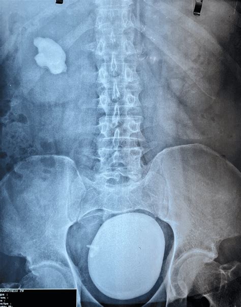 Kub X Ray Demonstrating The Stone Kub Kidney Ureter And Bladder