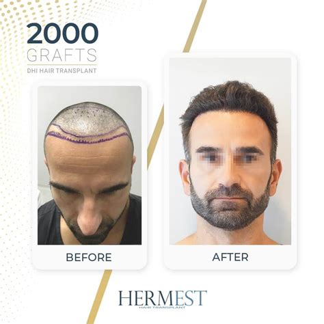 Hair Transplant Before And After Pictures And Experiences