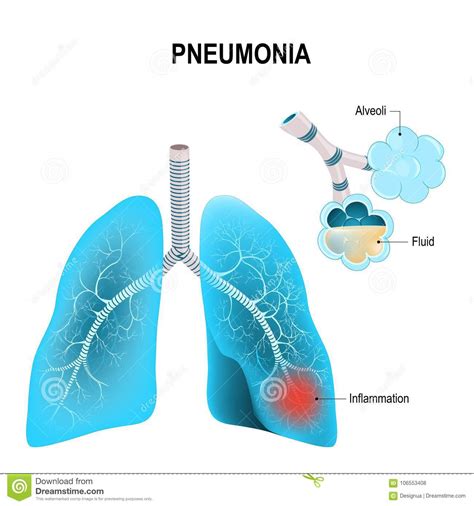 Pneumonia Human Lungs And Inflamed Alveoli Stock Vector