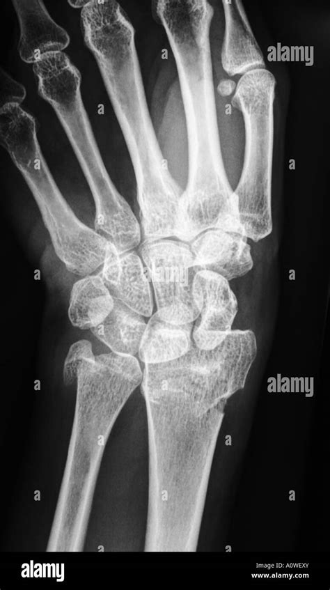 X Ray Of Human Hand With Broken Wrist Fracture Of Radius Xray