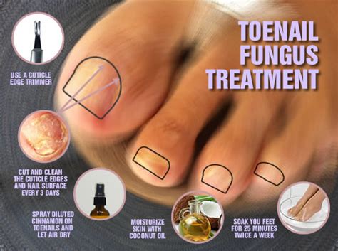 Best Toe Nail Fungus Treatment Its All About Pharma