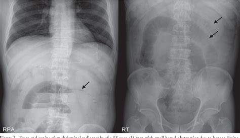 Figure 1 From Accuracy Of Plain Abdominal Radiography In The