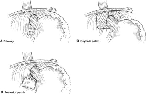 Open Repair Of Ventral Hernias Basicmedical Key