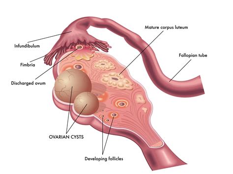 Know About Ovarian Cysts Cyst On Ovary Cysts Ovarian Cyst Sexiz Pix