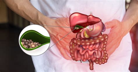 19 Home Remedies For Gallstones Your Body Will Love