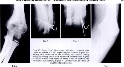 Figure 3 From Supracondylar Osteotomy Of The Humerus For Correction Of