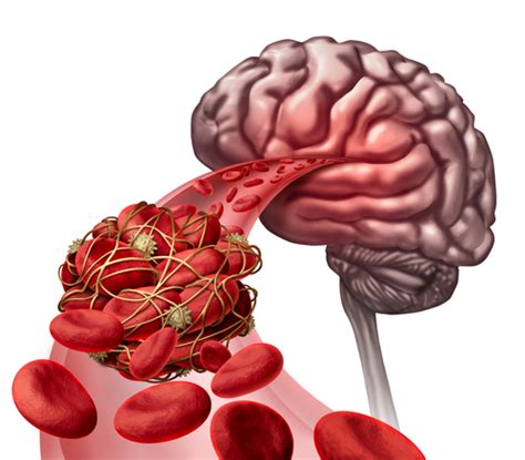 Qu Es La Trombosis De Senos Venosos Cerebrales