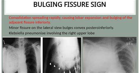 Chest Medicine Made Easy Dr Deepu Bulging Fissure Sign