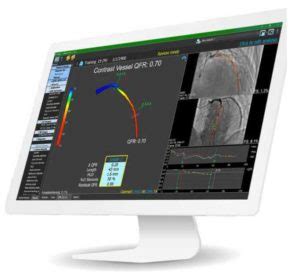 Intravascular Ultrasound Guided PCI HDi HD IVUS Catheter System