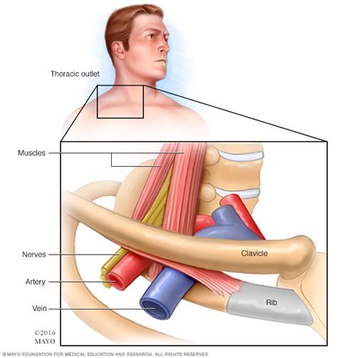 Case Study Thoracic Outlet Syndrome John Donohie Cmt