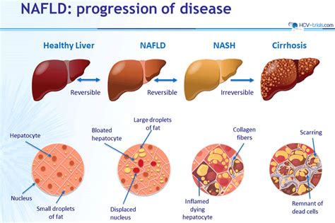 Non Alcoholic Fatty Liver Disease Emerging Concepts In Pathogenesis